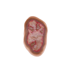 Laerdal Medical-Chemical Burn - Laerdal-MedTech-2